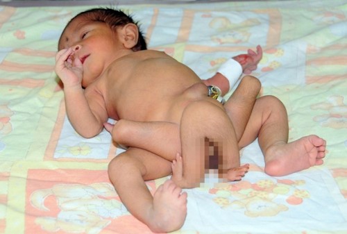 Doctors in Pakistan fight to save six-legged baby boy