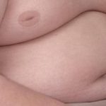 Gallstone risk 'higher among obese teenagers'