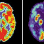 A combination image of brain scans show a normal functioning brain and one with Alzheimers. REUTERS/NIH