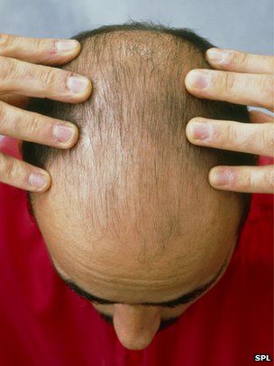 Male baldness 'indicates heart risk'