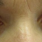 How Do We Manage Glaucoma