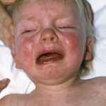 Threat to measles elimination plans