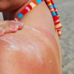 The Science of Sunburns
