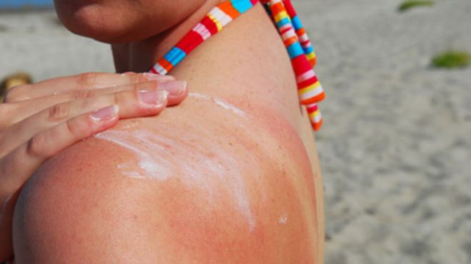 The Science of Sunburns