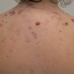 Tips On Dealing With Acne