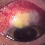 The Warning Signs Of Glaucoma