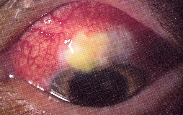 The Warning Signs Of Glaucoma