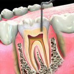 Root Canals - tuberose.com