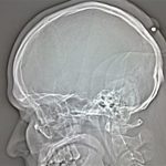 An X-ray shows a bullet lodged in the back of the head of a 35-year old Polish man