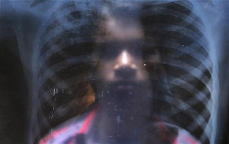 India, tuberculosis patient Ramzan