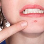 Tattoo-removal laser and Acne