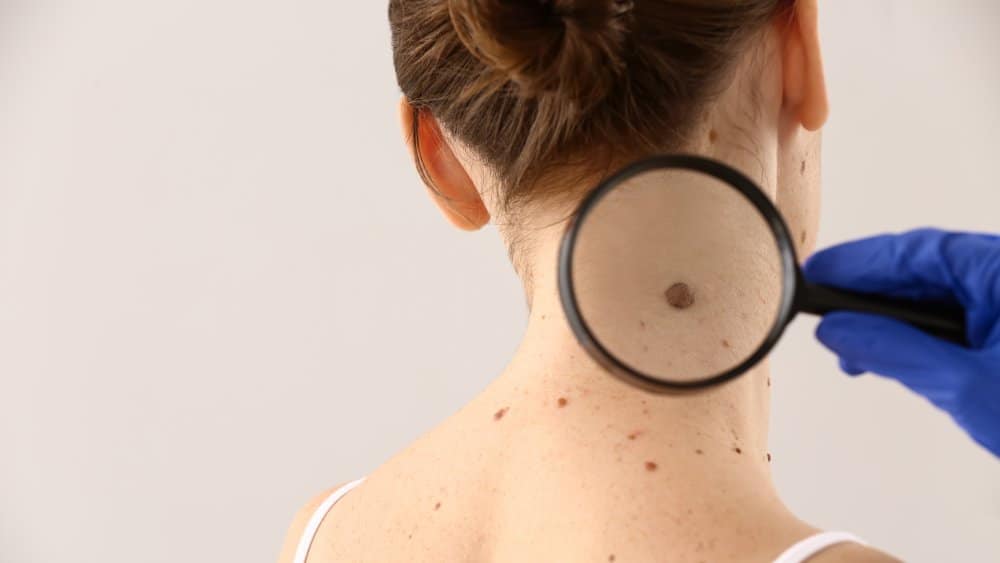 Mole removal