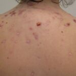 Natural Remedies for Acne