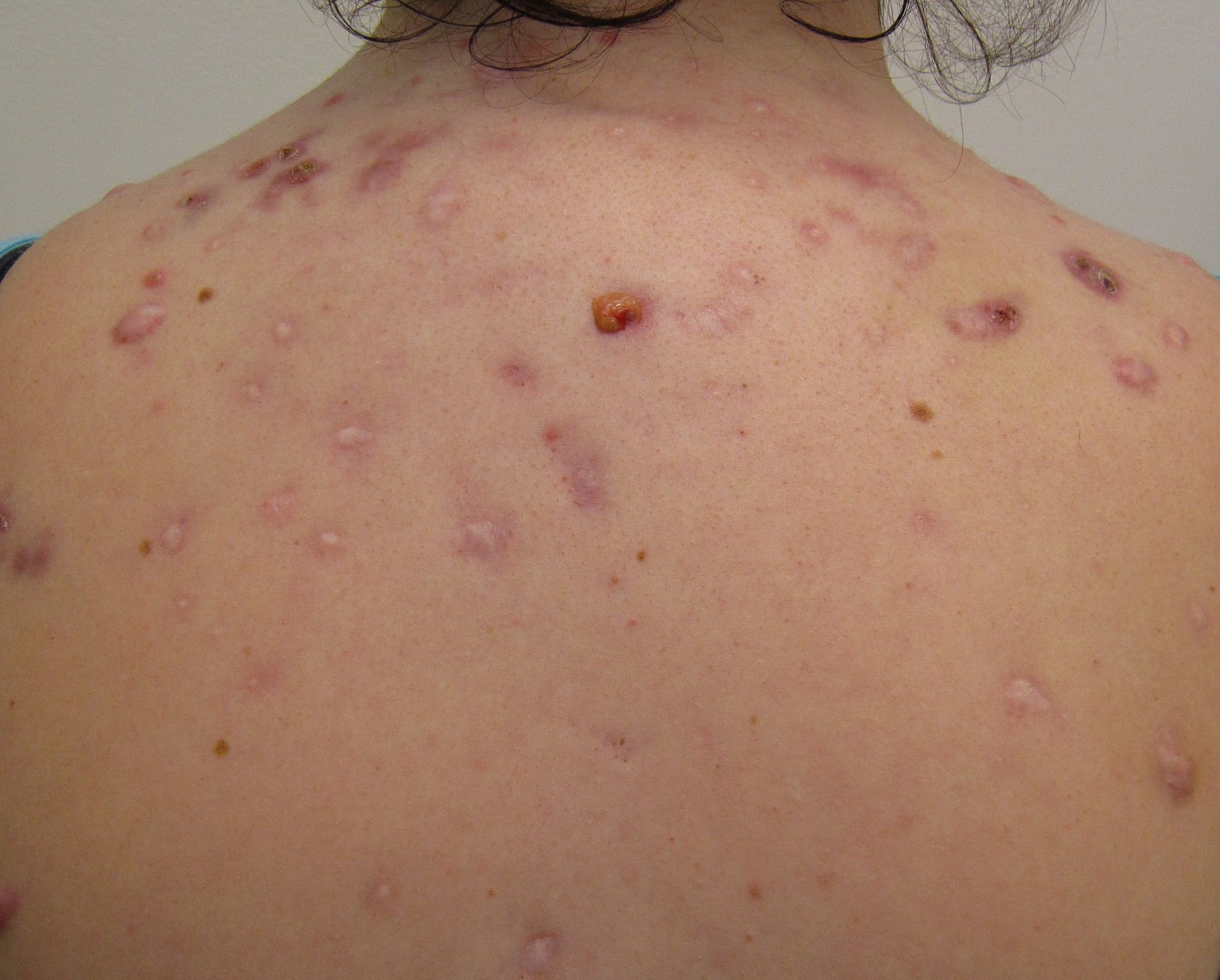 Natural Remedies for Acne